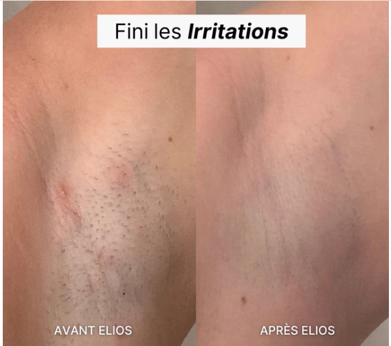 Rasoir Feminin Multifonctionnel 5-en-1 Elios