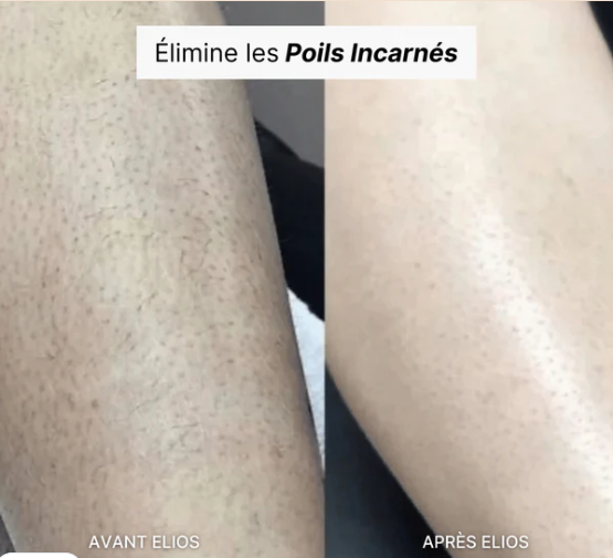 Rasoir Feminin  Multifonctionnel 5-en-1 Elios